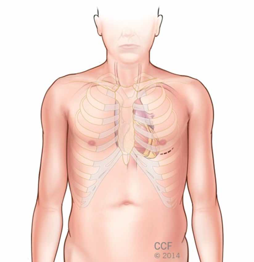 minimally invasive and robotically assisted heart surgery 5.png